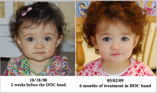 head-width-comparision-3-six-months-in-doc-bands1